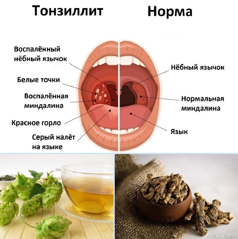 Лечение тонзиллита народными средствами