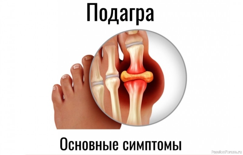 Подагра. Борьба с приступами в домашних условиях Подагра. Борьба с приступами в домашних условиях